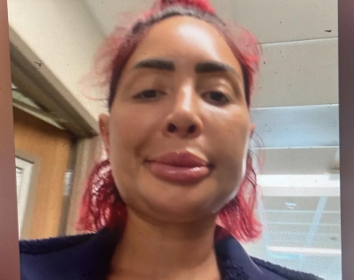 Farrah’s Face After Surgery